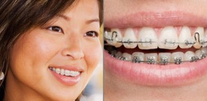 Clear-Combo-Braces