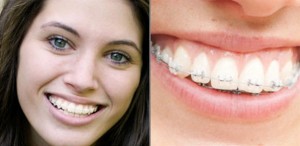 Crystal-Clear-Braces